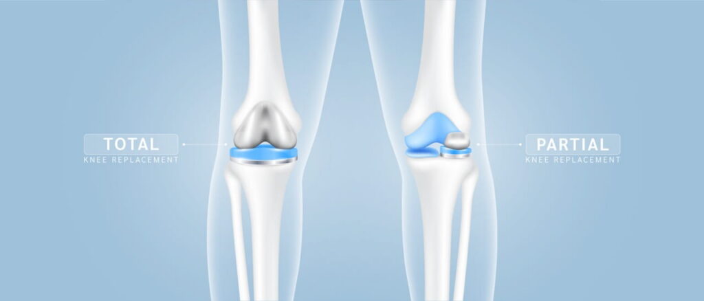 Graphic depicting total vs partial knee replacement