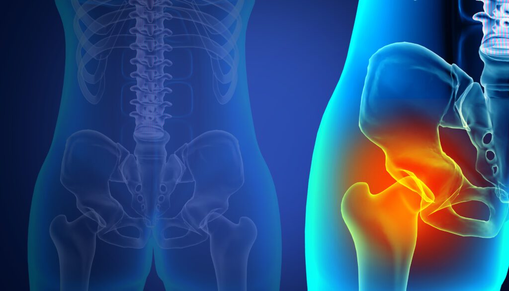 hip pain illustration