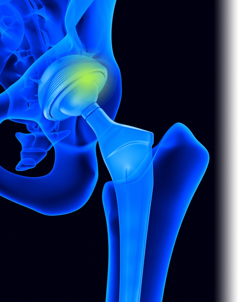 can-you-run-after-hip-replacement-surgery