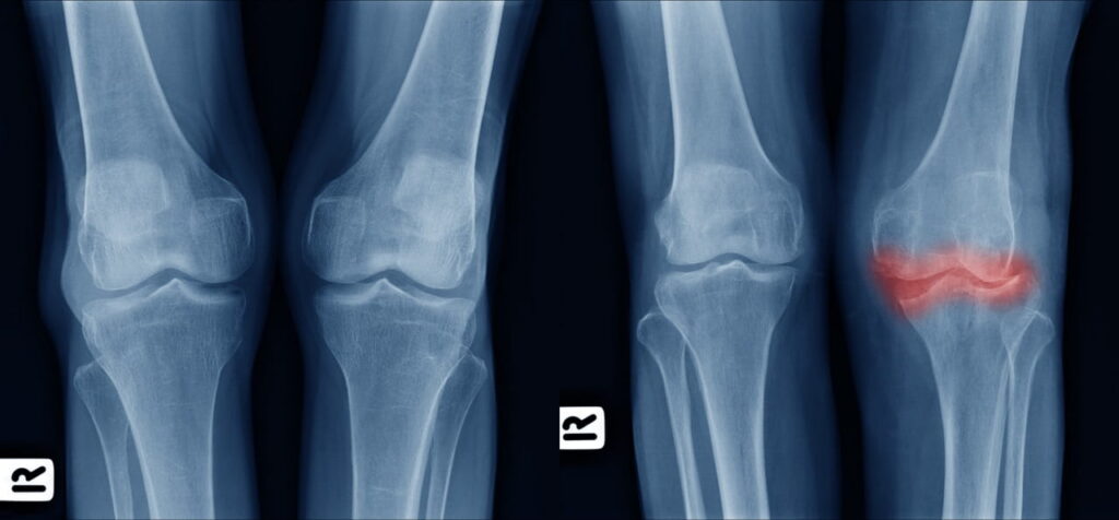 Knee x-ray