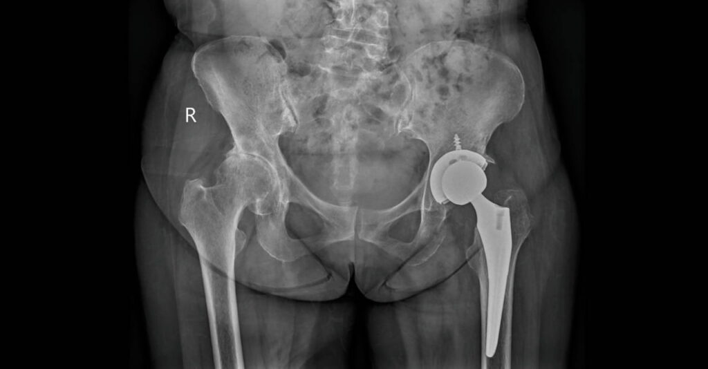 Hip x-ray