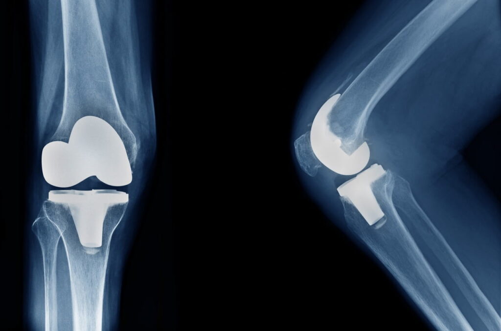 Knee x-ray