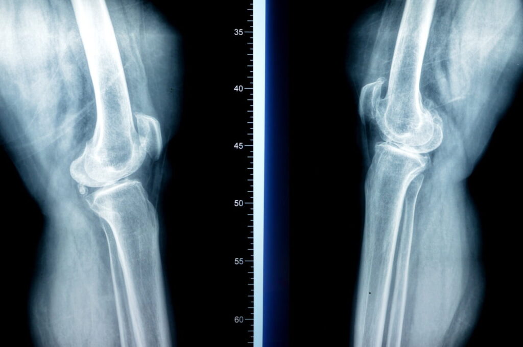Knee x-ray